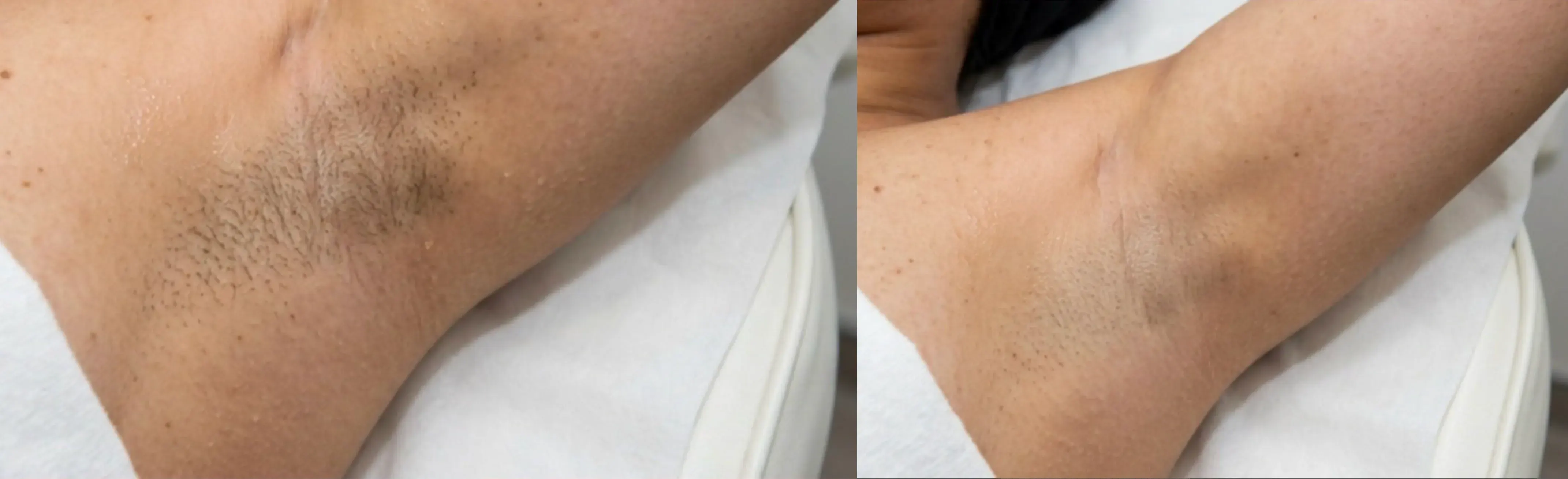 Laser Hair Removal Elite iQ | Cambridge, MA — Before and After