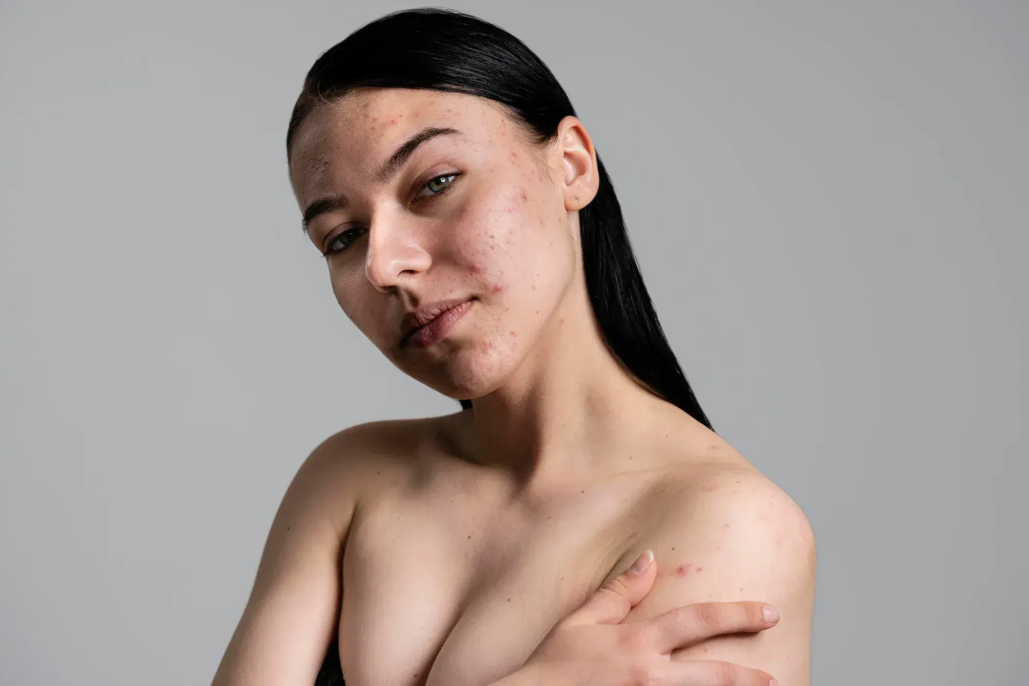 Person concerned about acne-prone skin at Radiant Laser MD Cambridge