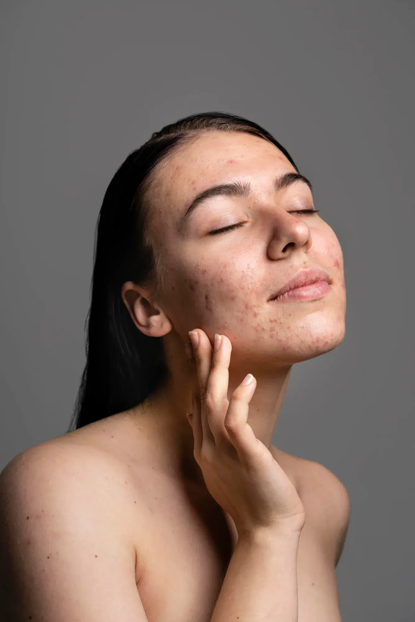 Patient examining acne scarring in mirror at Radiant Laser MD Cambridge