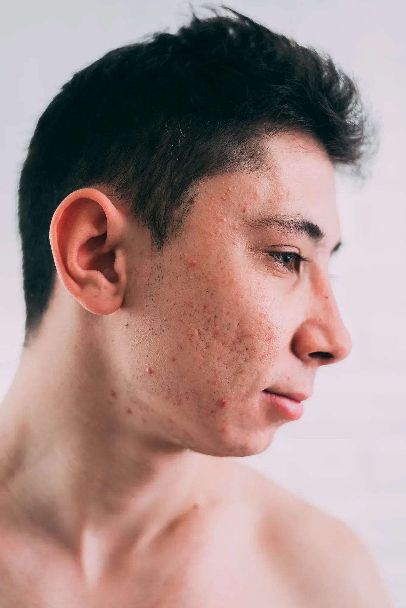 Person examining acne scarring on cheeks at Radiant Laser MD Cambridge