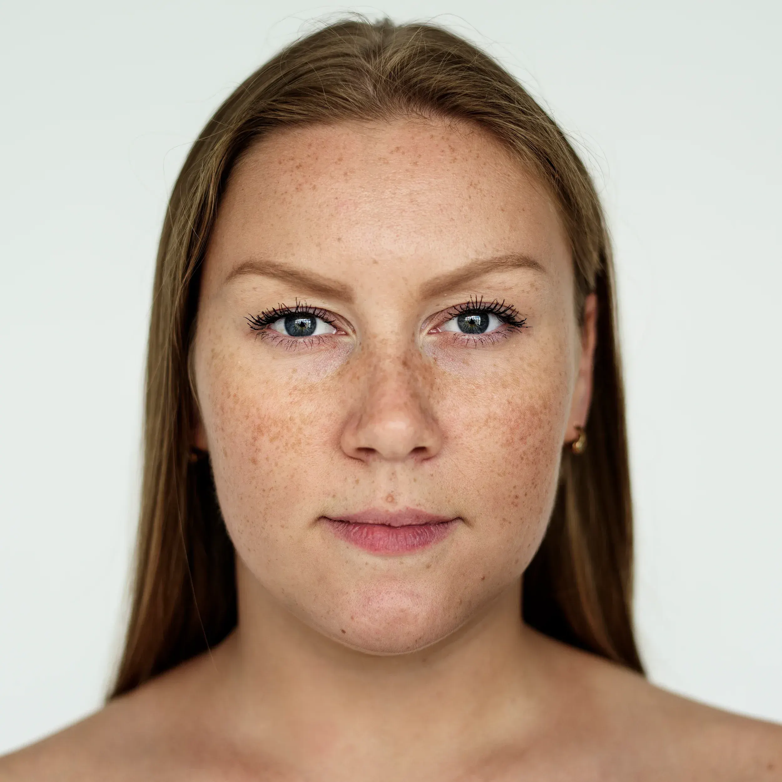 Close-up of hyperpigmented patches on a patient's cheek at Radiant Laser MD