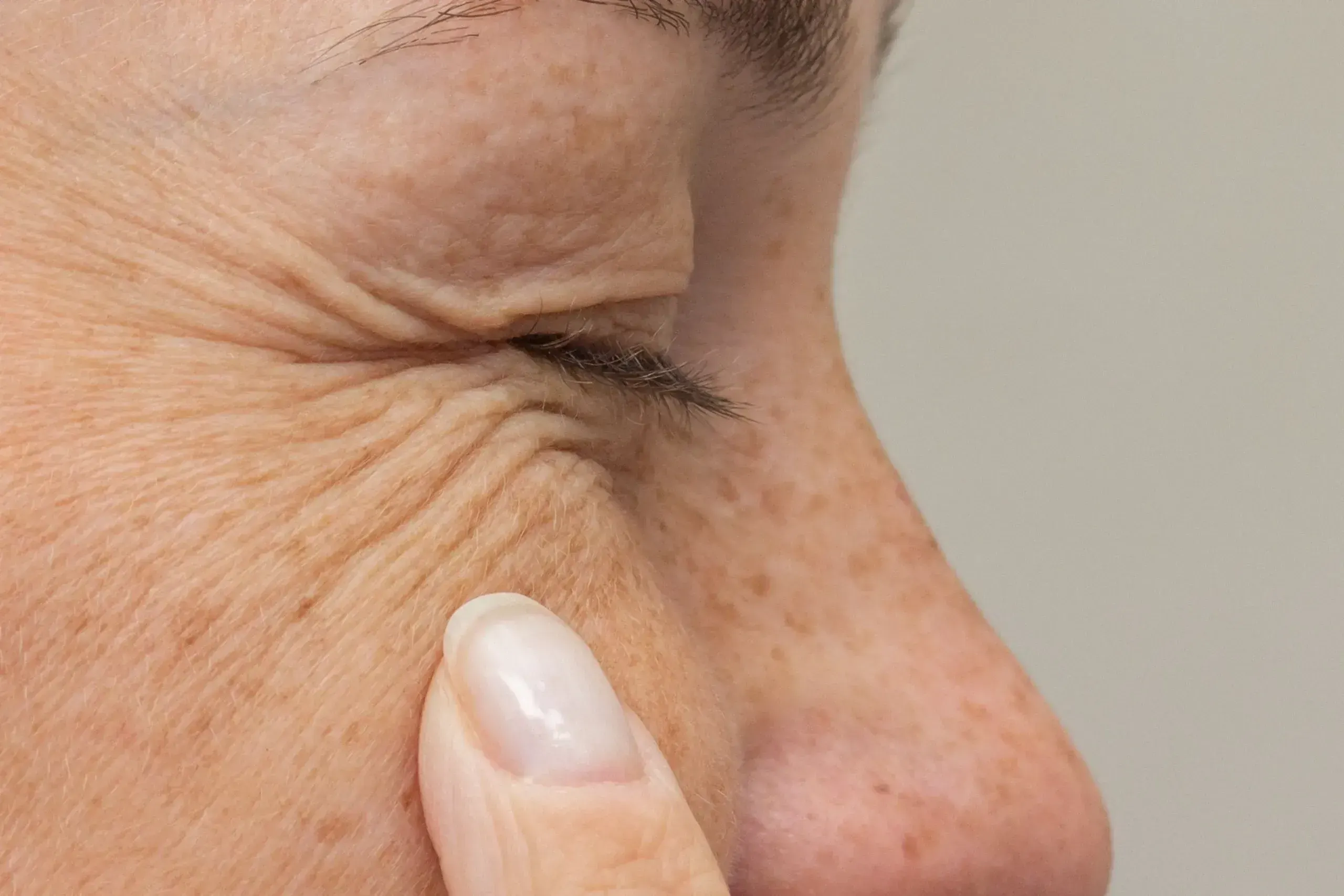 Close-up of fine lines around the eyes at Radiant Laser MD Cambridge